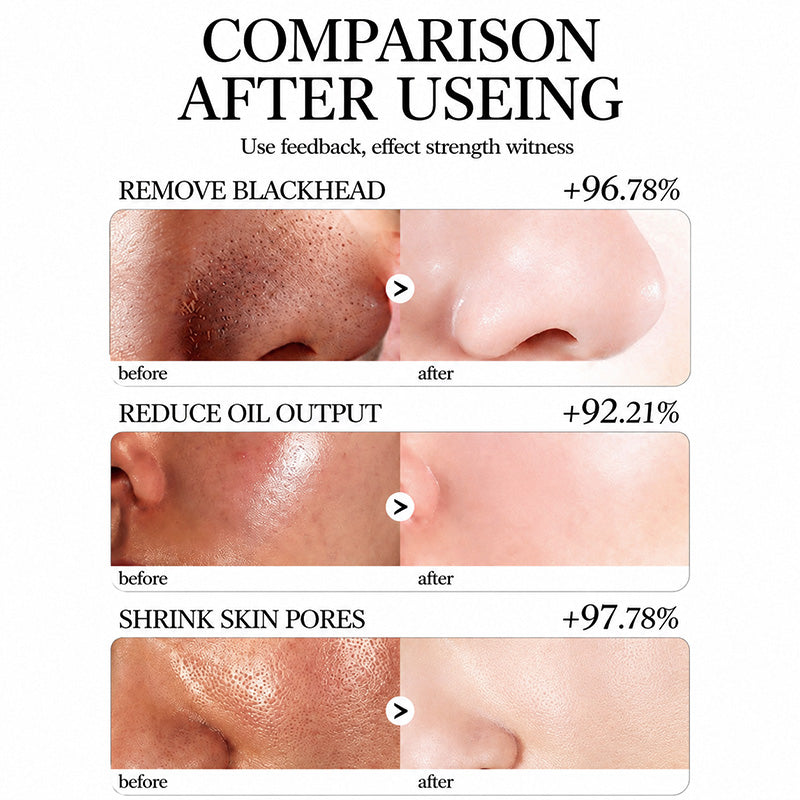 💥Hot Sale🍓Suncrese® 2026 Next-Gen Anti Pores & Acne Clay Mask Stick